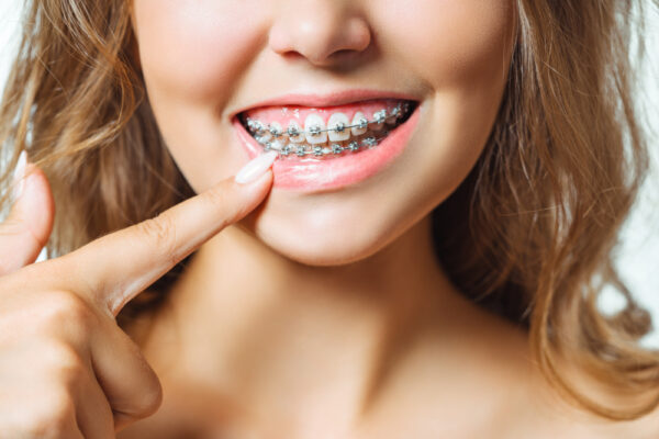 Poți mesteca gumă dacă porți aparat dentar?