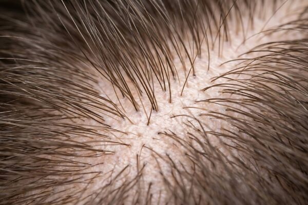 Rărirea părului la cărare: când poate fi alopecie androgenetică