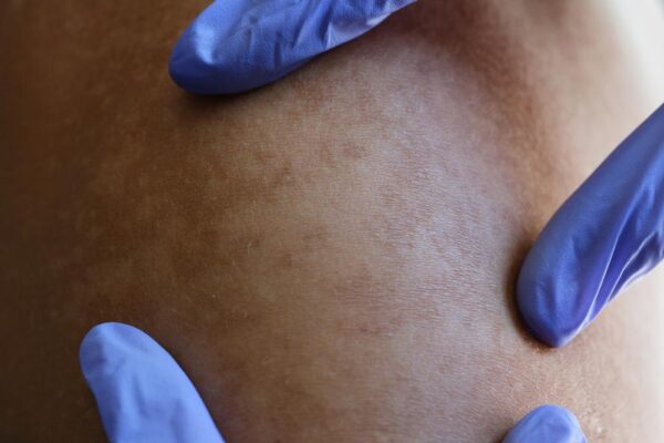 Vitiligo: ce opțiuni de îngrijire și tratament se discută la consultație