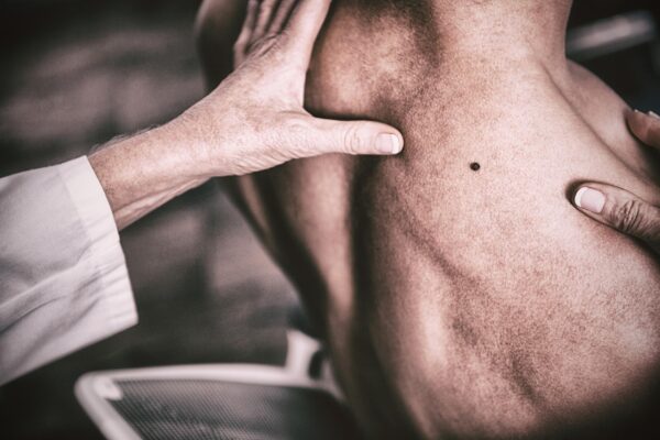 Melanomul: ce influențează tratamentul după confirmarea diagnosticului